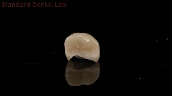 Trò kính răng Circonia Crown Inlay Onlay Crown để khôi phục hình dạng khoang tự nhiên