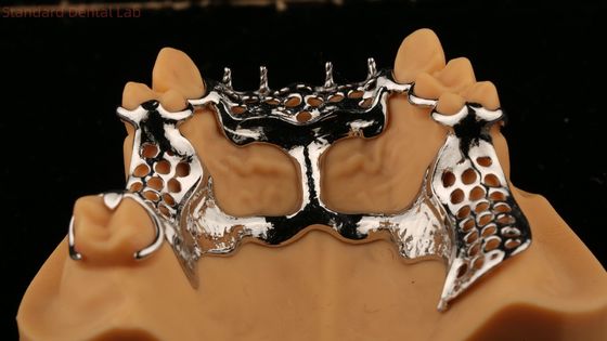 Hình khung đúc phía trên Acrylic kim loại răng giả một phần mạnh mẽ nhẹ và bền