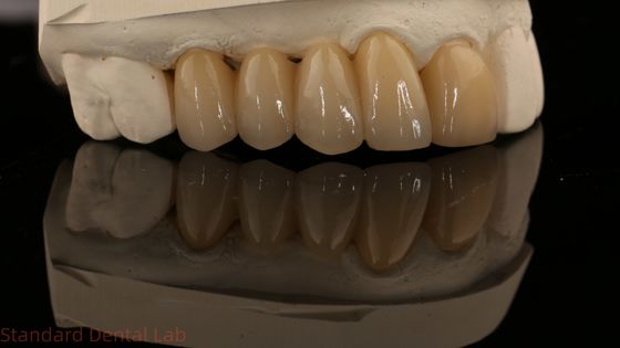 Noritake Porcelain Full Contour Zirconia Crown High Aesthetic Đường cầu nha khoa Zirconia tự nhiên tùy chỉnh