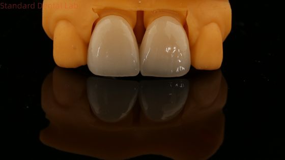 Bảo hành 5 năm Full Contour Zirconia Crown Customized Vita Shade High Aesthetic Natural Dental Bridge