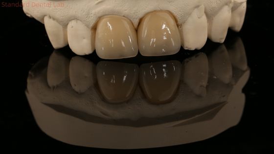 Full Contour Zirconia Crown và High Aesthetic Natural Dental Bridge Bảo hành 5 năm
