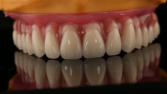 Acrylic phần cấy ghép trên răng giả Tianium thanh răng giả đầy đủ thiết lập ốc vít giữ