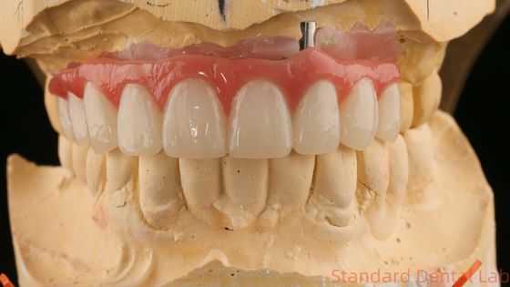 Tốt phù hợp chính xác thẩm mỹ Zirconia Porcelain Crown Pink Porcelain với màu trắng