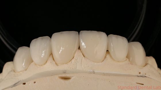 Đường cầu vương miện Zirconia chính xác Thích hợp / thẩm mỹ thoải mái 3-4 ngày Thời gian quay nhanh