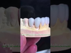 Emax Veneers trông tự nhiên Crown Biocompatibility Màu trắng với chuẩn bị tối thiểu